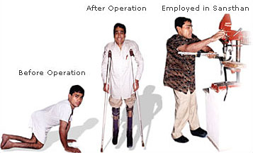 Narayan Seva Sansthan: Helping Polio Victims