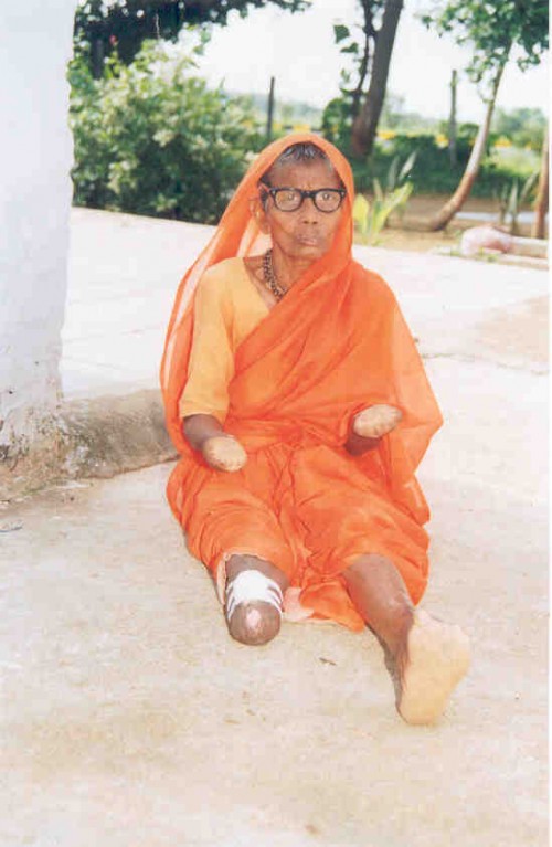 One of the leprosy-affected women at Sahyog village