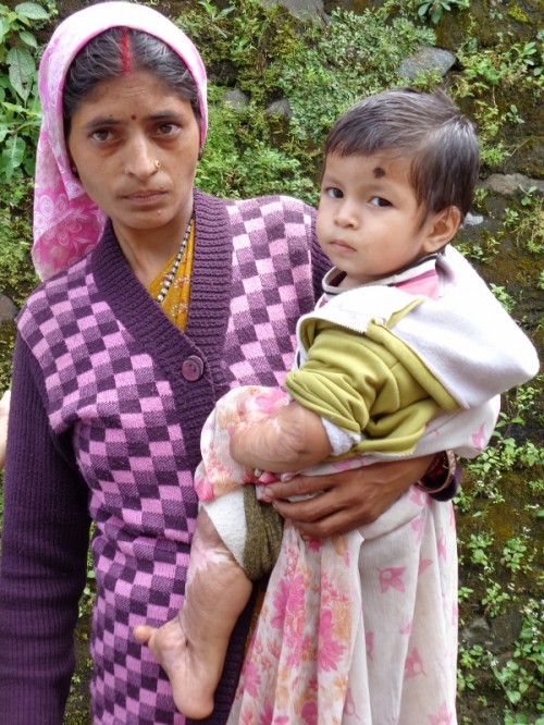 Young Prati with her mother before surgery.