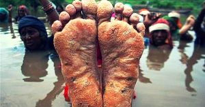 After 32 days of protesting in water - Jal Satyagraha is peeling off soles, not determination