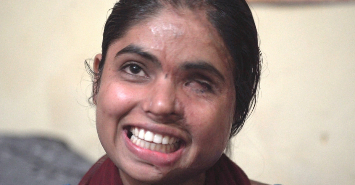 TBI BLOGS: 13 Surgeries Later, This Acid Attack Survivor Still Has the Spirit to Fight it Out
