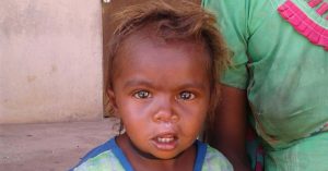 TBI Blogs: How Doctors and Support Workers Came Together to Help a 3-Year-Old Girl Born with a Cleft Lip
