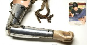 Delhi High Court Gives 16-Year-Old Foot Artist New Lease of Life With a Prosthetic Arm!