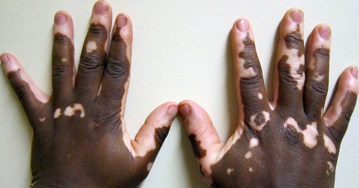 vitiligo universalis definition