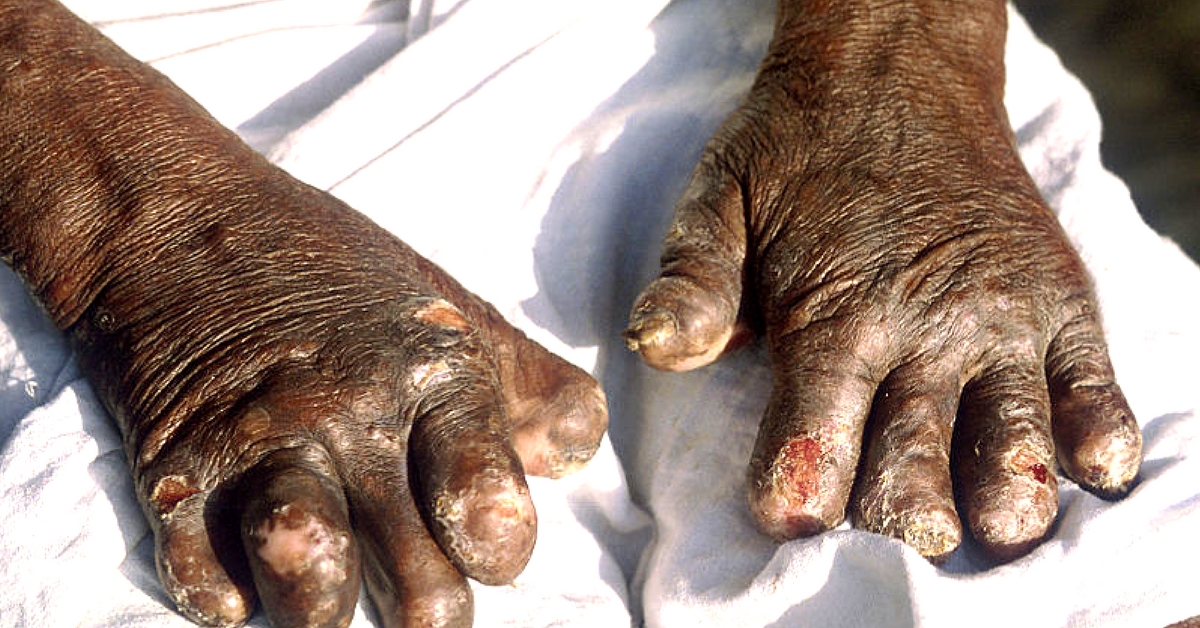 Leprosy as a disease is debilitating, but what is worse is the social stigma. Representative image only. Image Courtesy: Wikimedia Commons.