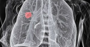 NIT Trichy Students' Unveil Low-Cost Device That Helps Detect Lung Cancer Early!