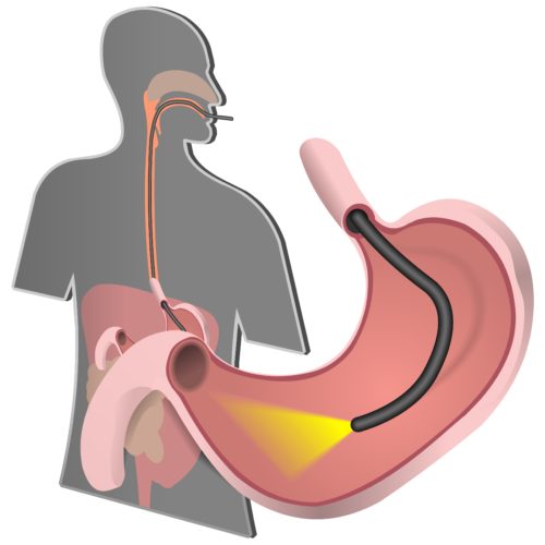 endoscopy technique minimum invasive surgery