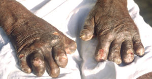 Prevent Stigma, Eradicate Leprosy: Why Indians Must Care About The SC's Directions