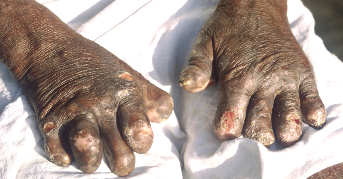 Prevent Stigma, Eradicate Leprosy: Why Indians Must Care About The SC’s Directions