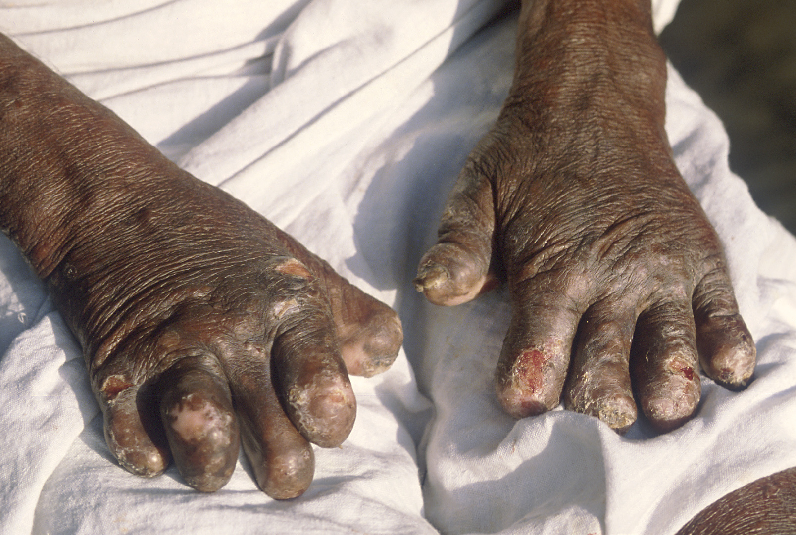 Leprosy-inflicted deformities on the hands. (Source: Wikimedia Commons)