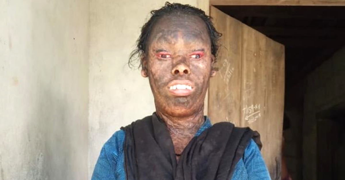 Ridiculed For Her Face, Kerala Woman Is Fighting Her Destiny & Needs Your Help