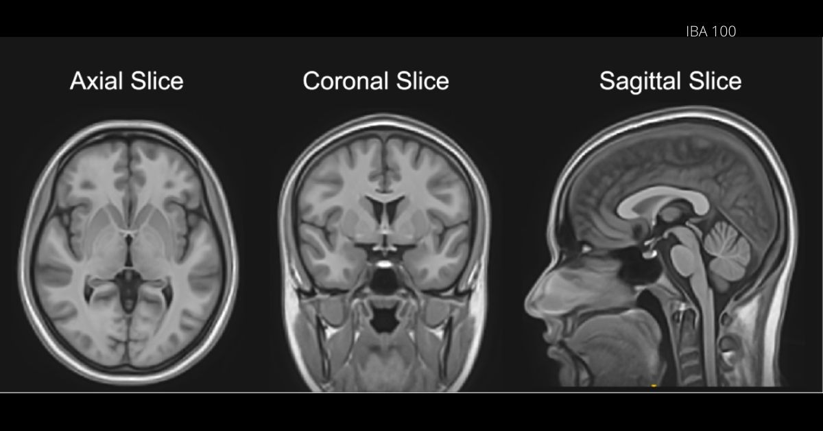 India’s First Brain Atlas Created by IIIT-Hyd: A Big Step in Treating Alzheimer’s, Dementia