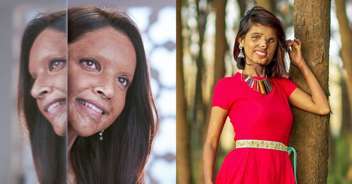 acid attack survivor