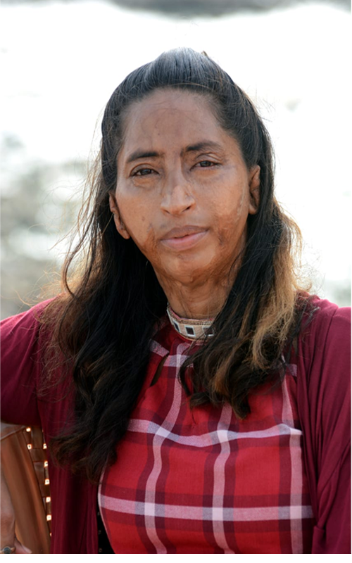 acid attack survivor