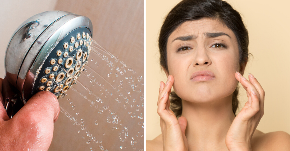 Hard Water Ruining Your Skin? 5 Simple Steps To Keep It Soft And Hydrated!