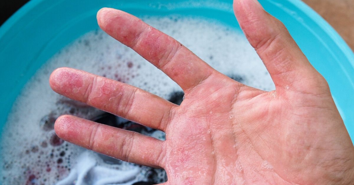 Fighting Eczema? 5 Easy Ways to Make Your Laundry More Skin-Friendly