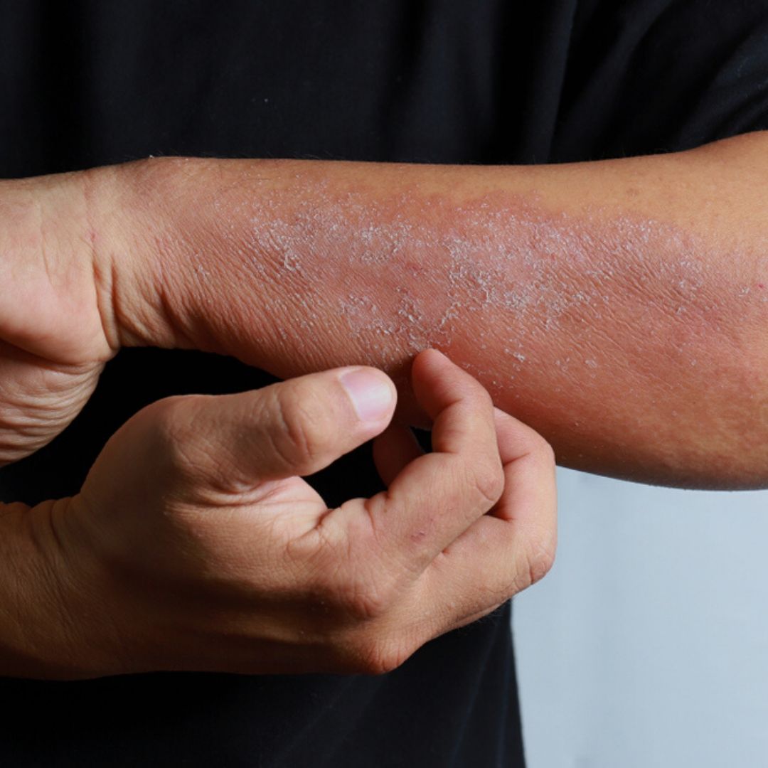 Fighting Eczema? 5 Easy Ways to Make Your Laundry More SkinFriendly