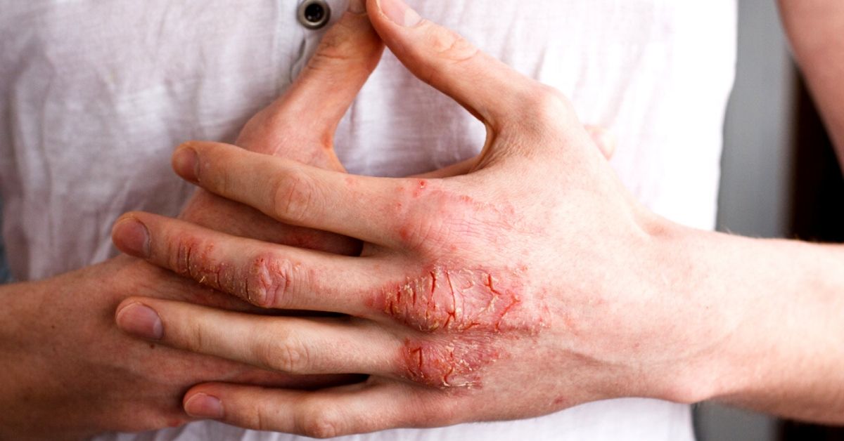 Allergic reaction or dry skin? I just washed my hands and once the soap hit  the back of my hands they turned red like this. They were itchy, tingly,  and burned a