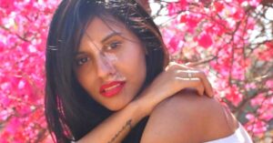 ‘As a Teen, I Hated My Face’: Model With Vitiligo Shares Inspiring Story