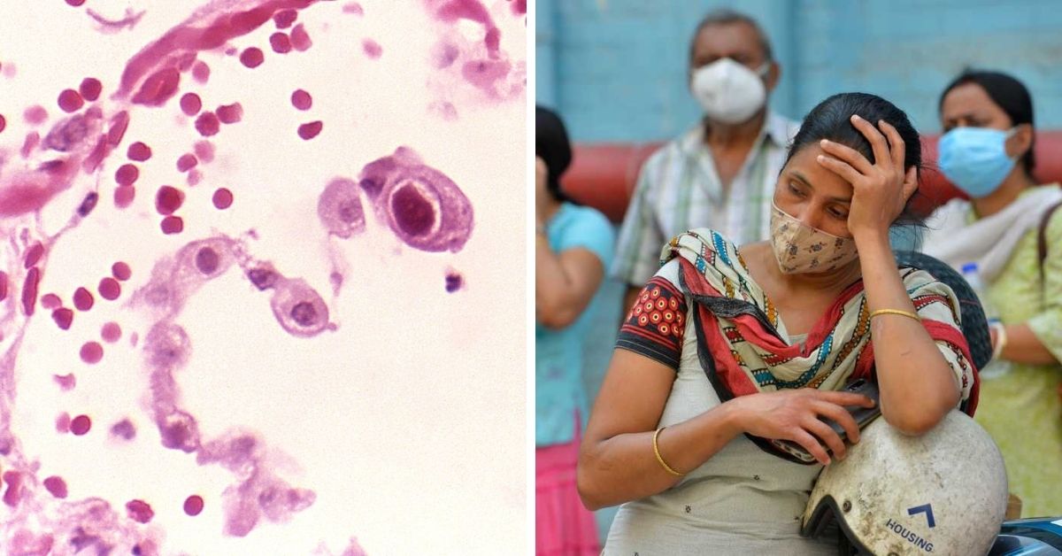 Cytomegalovirus Cases Detected in Delhi, Kolkata: What You Need to Know