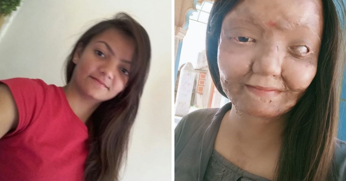 ‘His Acid Attack Took My Eye But I Won’t Let It Take My UPSC Dreams’