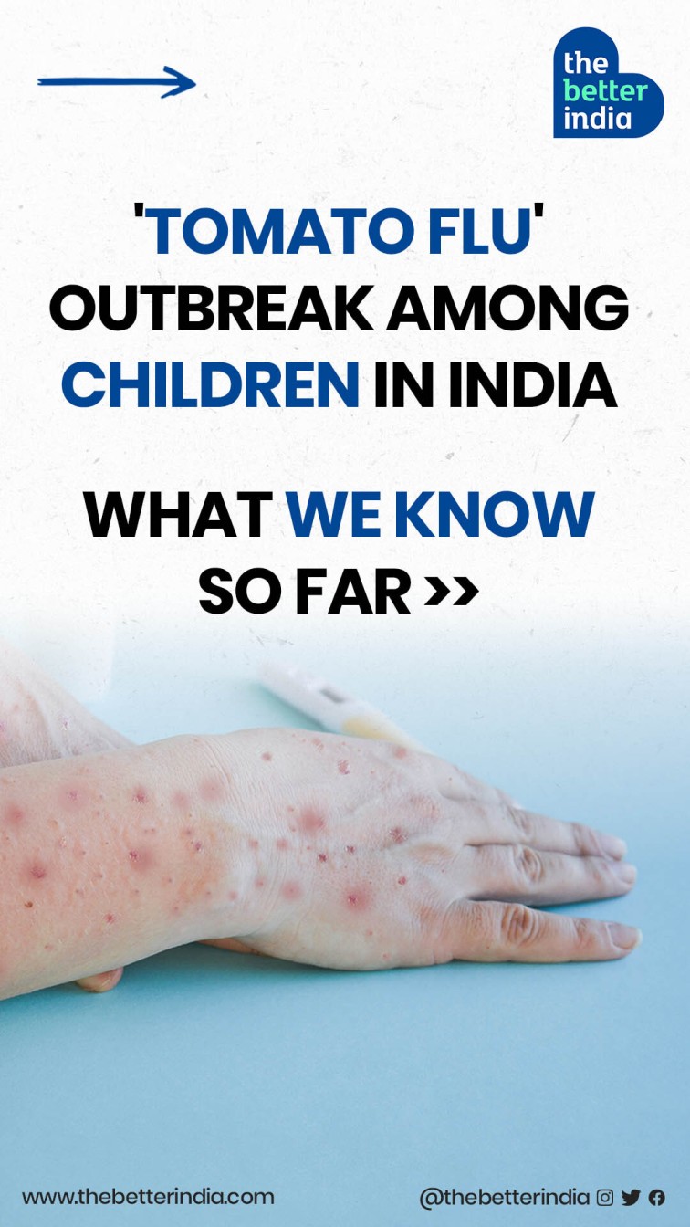 ‘Tomato Flu’ Outbreak Among Children In India; What We Know