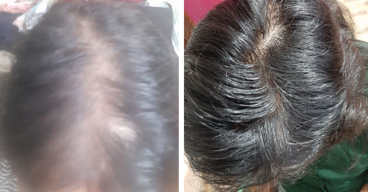 A customer was facing severe hair loss in June 2022 (L) and was helped by Traya. With the treatmentplan his hair has now regrown. 