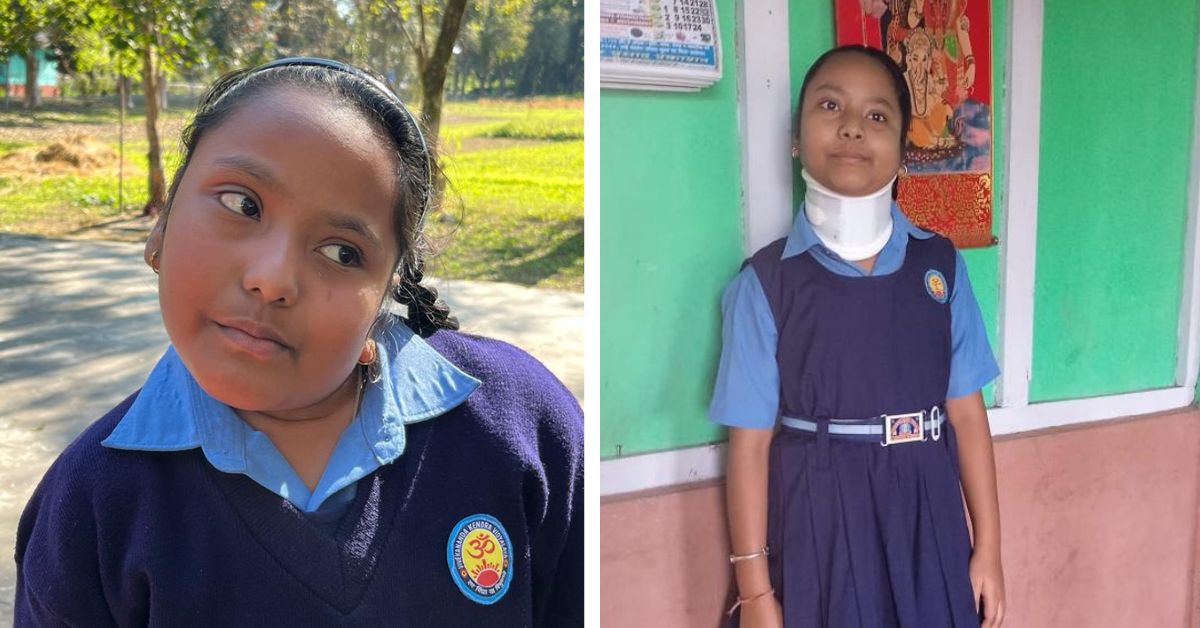 Muskan before the operation (L) and Muskan two weeks post-surgery (R)