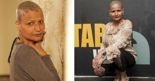 Living With Alopecia: 'I Stopped Hiding and Made My Baldness My Strength'