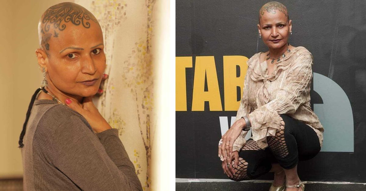 Living With Alopecia: ‘I Stopped Hiding and Made My Baldness My Strength’