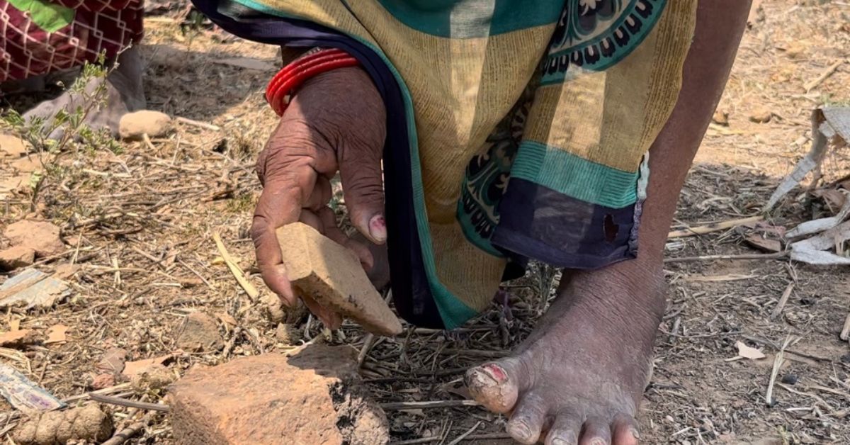 The labourers often develop calluses and corns and infections as a result of working in harsh terrain without any protection for their feet