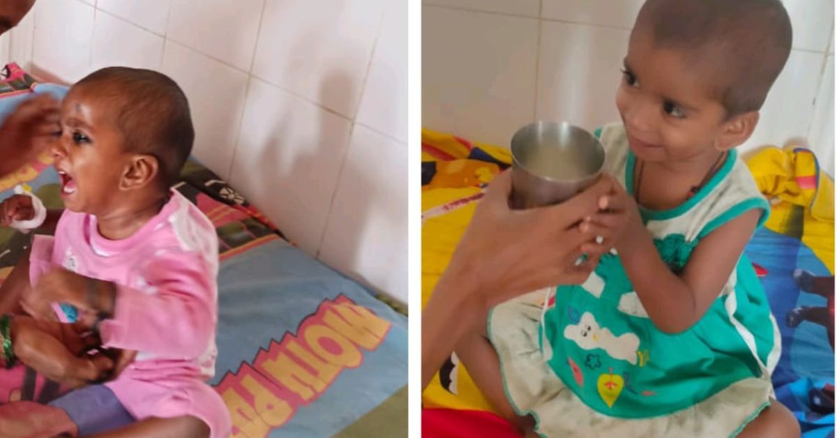 Before and after images of Vartika who received nutrition care at a Mini Nutritional Rehabilitation Centre (NRC).