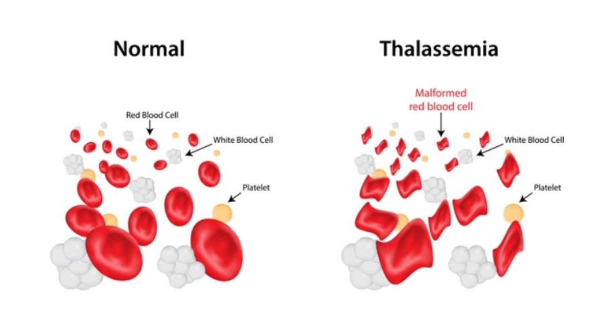 Thalassemia major is characterised by faulty haemoglobin synthesis